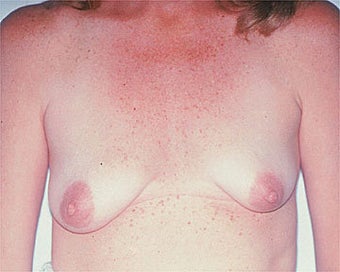 Breast Asymmetry Correction before 281313