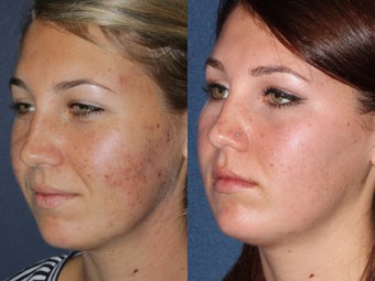 PDT & Fraxel Restore Before and After before 1033864