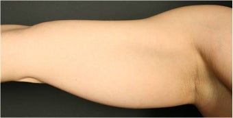 SmartLipo MPX before 686068