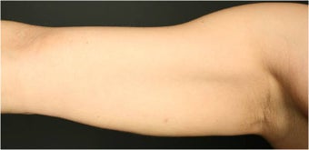 SmartLipo MPX after 686068