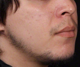 Isolaz and Chemical Peel for Acne 539879