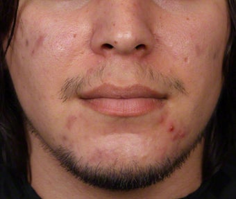 Isolaz and Chemical Peel for Acne before 539879
