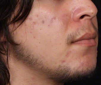Isolaz and Chemical Peel for Acne 539879
