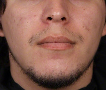 Isolaz and Chemical Peel for Acne after 539879