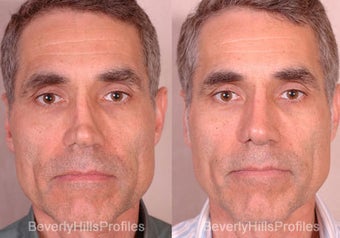 Revision Rhinoplasty before 681868