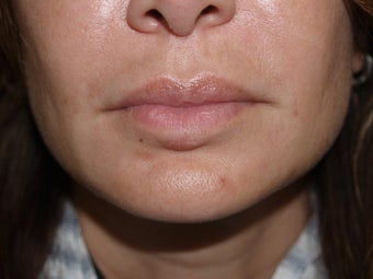 Extensive repair of scarring and deformity as a result of silicone and BioPolymer lip injections after 695976
