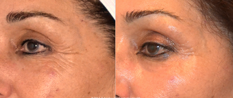 Ultherapy skin tightening of the upper face before 1032289