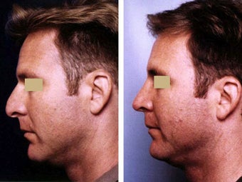 Rhinoplasty before 109659