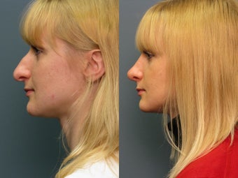Nose Surgery 338483