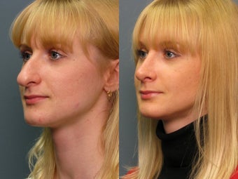 Nose Surgery after 338483