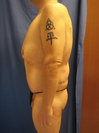 Body Lift After Weight Loss after 364635