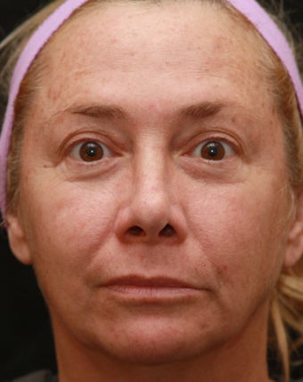 Fraxel Repair for Sun Damage before 110212