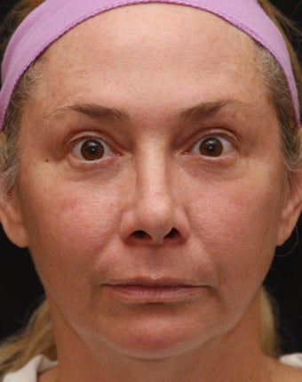 Fraxel Repair for Sun Damage after 110212