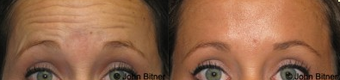 Botox before 1156433
