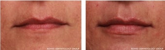 50 Year Old Woman treated for Lip Enhancement before 1035707