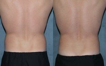 Zeltiq for fat reduction on "love handles" before 183869