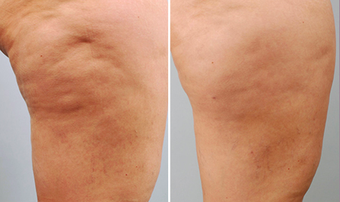 Cellulaze before 996932