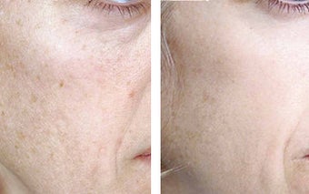 TCA Chemical Peel with 35% TCA before 6347