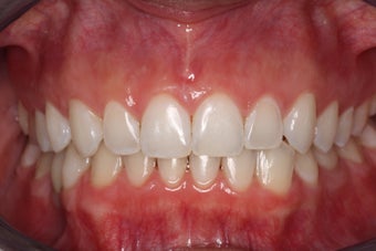 Braces, Gingivectomy, Bonding, Porcelain Crowns, Implant after 469005