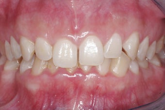 Braces, Gingivectomy, Bonding, Porcelain Crowns, Implant before 469005
