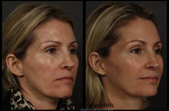 Sculptra after 316998