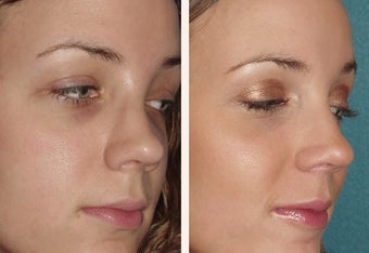 4 female who broke her nose in an automobile accident 666464