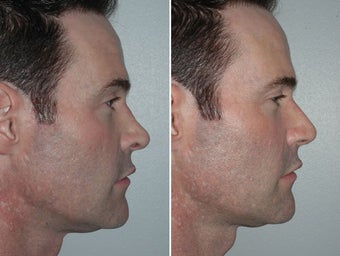 Revision Rhinoplasty after 229628