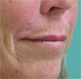 Juvederm to the upper lip after 77463