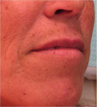 Juvederm to the upper lip before 77463