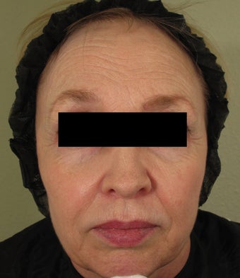 Facial rejuvenation with Sculptra, Dermapen, and Botox before 772537