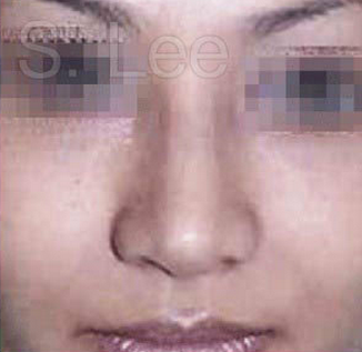 Nose after 431426