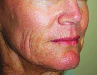 Fractional CO2 Laser after 901962