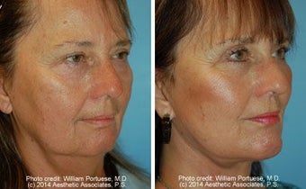 Facelift, Upper and Lower Blepharoplasty and Chin Implant before 162251