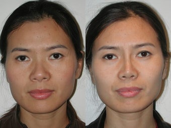 Asian Rhinoplasty before 922060
