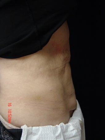 Coolsculpting Abdomen 384557