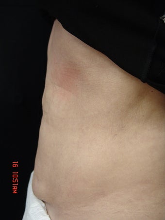 Coolsculpting Abdomen after 384557