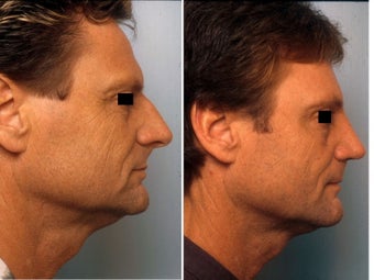Rhinoplasty before 139110