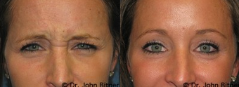 Botox before 1156432