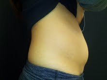 Coolsculpting before 503135