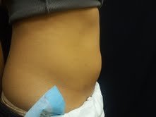 Coolsculpting after 503135