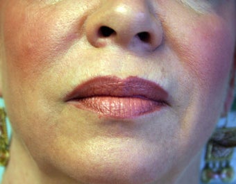 Restylane after 1070412