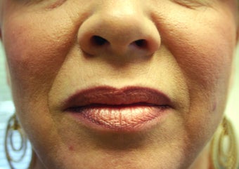 Restylane before 1070412