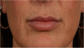 44 year old female with thin lips after 766102