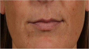 44 year old female with thin lips before 766102