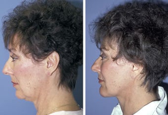 Face lift with chin implant side view before 6766