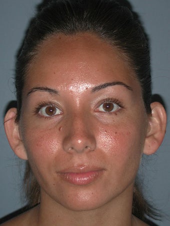 Otoplasty/Ear Surgery before 731969