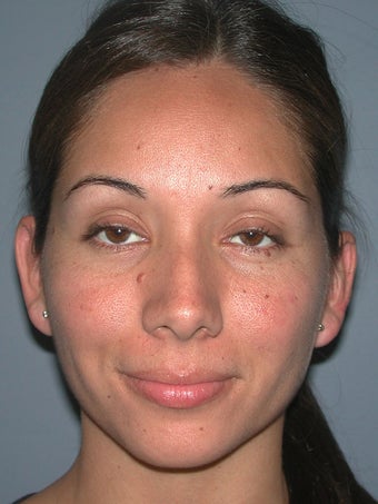 Otoplasty/Ear Surgery after 731969