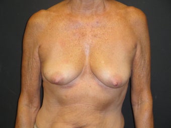 Breast reconstruction - tissue expanders after 884526