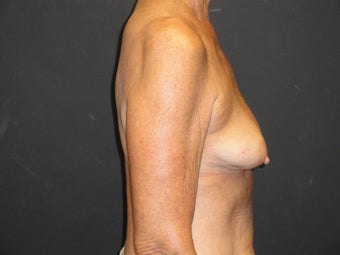 Breast reconstruction - tissue expanders 884526