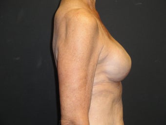 Breast reconstruction - tissue expanders 884526